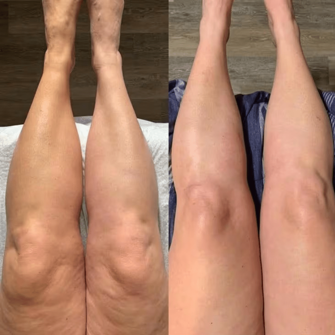 Drainage Lymphatique Naturel – Silhouette affinée, jambes légères, ventre plat - Soxelle