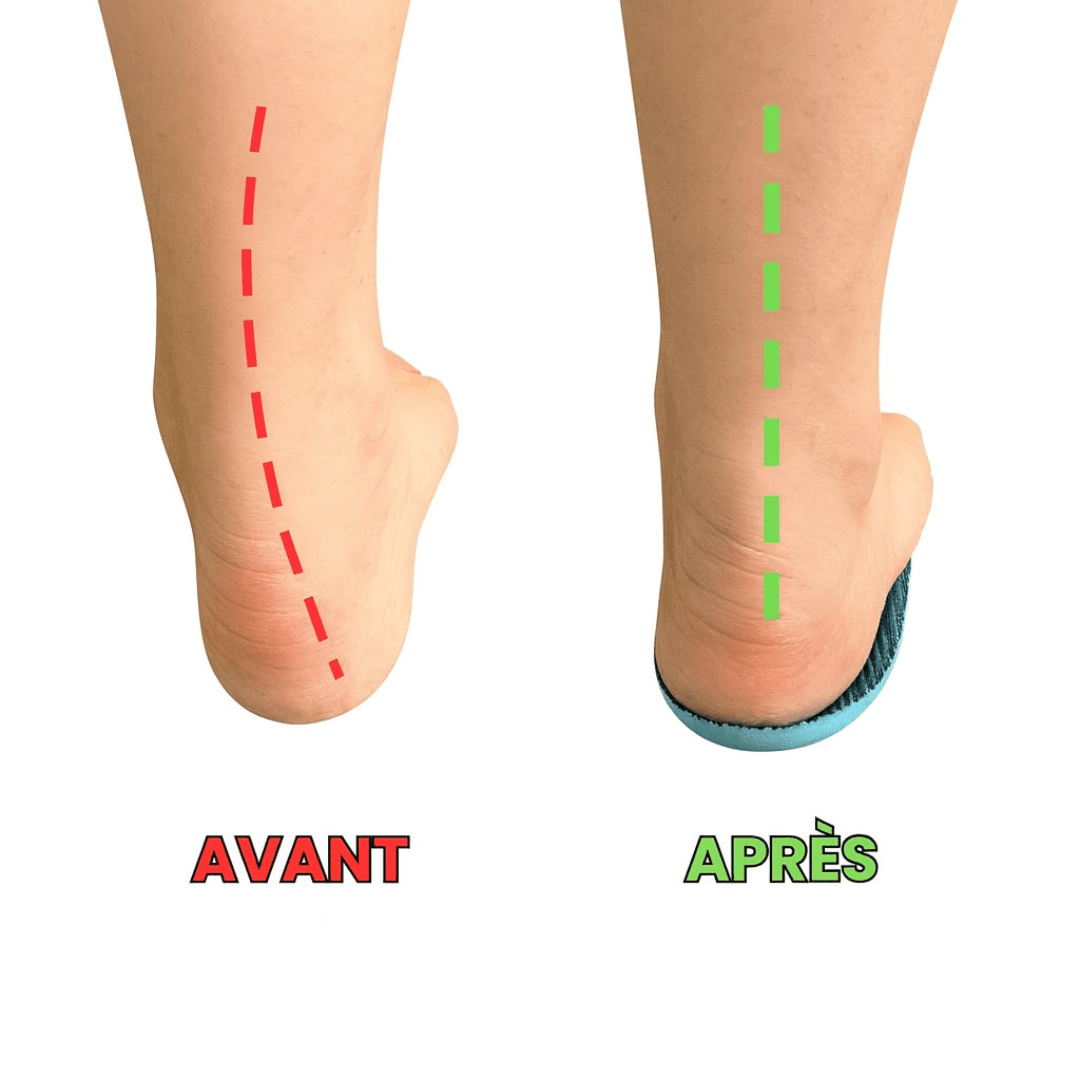 Semelle Orthopédique - Redresse et soulage vos orteilles - Soxelle