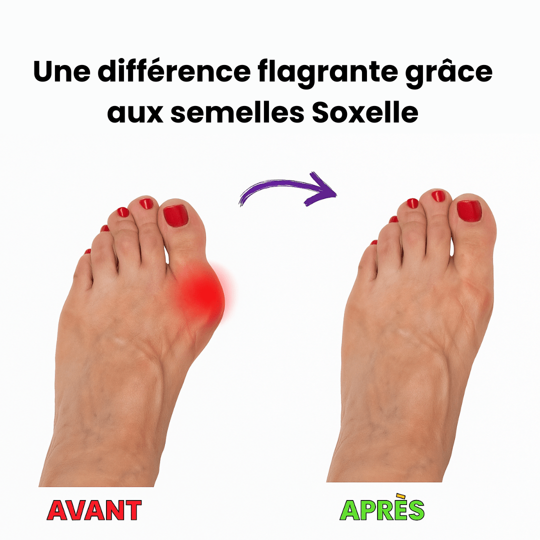 Semelle Orthopédique - Redresse et soulage vos orteilles - Soxelle