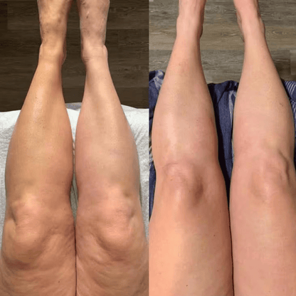 Drainage Lymphatique Naturel – Silhouette affinée, jambes légères, ventre plat - Soxelle