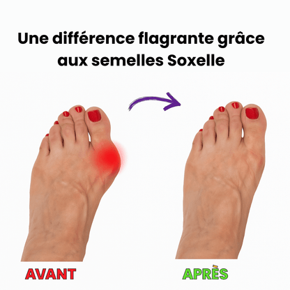 Semelle Orthopédique - Redresse et soulage vos orteilles - Soxelle